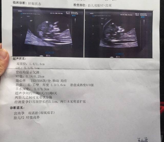 在江苏南通做供卵试管婴儿一般要花费几万